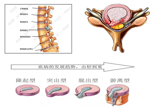 椎间盘椎间盘讲解康奇特
