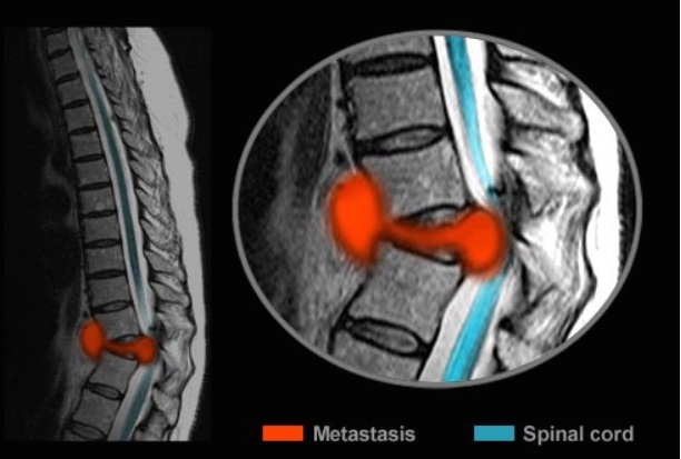 从临床实际情况看很多人在30岁之后,或多或少的会出现腰椎间盘突出的情况,这是由于腰椎间盘退行性改变造成的,可以说是人体逐渐衰老的正常变化,但这些人并没有任何临床症状,只有极少数人在一定的外因刺激下出现症状,成为腰椎间盘突出症患者。因此千万不要把腰椎间盘突出和腰椎间盘突出症等同起来当做是一回事13.什么是无菌性炎症引起人体产生炎症的原因很多,从大的方面可分为感染性炎症和无菌性炎症两大类。人体因为受到病原微生物和细菌、病毒、原虫等感染,并引起人体炎症反应的统称感染性炎症。而由物理、化学等因素引起的炎症反应,统称无菌性炎症。也就是说当人体发生无菌性炎症时,在炎症部位并没有细菌等病原体感染,所以用抗生素等药物也是没有必要的。能够导致人体发生无菌性炎症的因素很多,主要是一些物理、化学因素刺激。比如过敏反应、软组织的机械性损伤、皮肤被灼伤或接触强腐蚀性物品等,都会引起人体局部组织产生渗出、坏死和增生等炎症反应,而形成无菌性炎症。